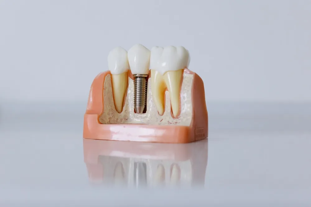Dental implant screw inserted into jawbone